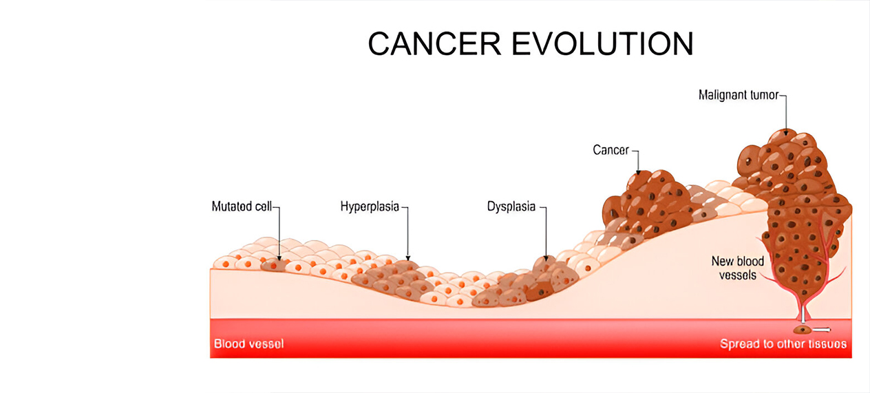 Cancer Stages Explained: A Guide To Diagnosis And Treatment